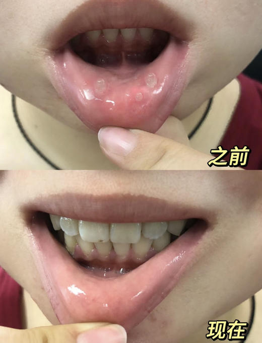 【多妈团购 Breathy布雷辛舒口宁口腔喷雾】溃疡肿痛，一喷很快就不痛了，10秒成膜·冰镇舒缓，喝水无痛，牙龈肿痛/咽喉不适，快速修护，修复黏膜·长效防护-美初 商品图7