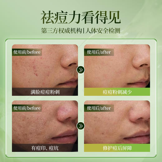 【社群福利】嘉媚乐茶树祛痘控油修护精油 修护愈创 淡化痘印 商品图3