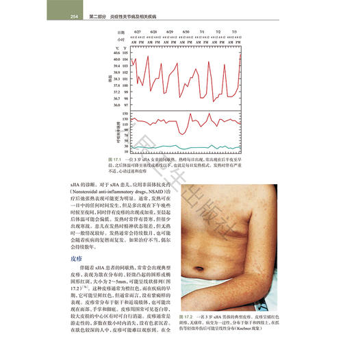 儿童风湿病学 第8八版 宋红梅 主译 介绍了儿童风湿病诊断方法常用药物及辅助检查儿童慢性关节炎炎症性结缔组织 病人民卫生出版社 商品图4