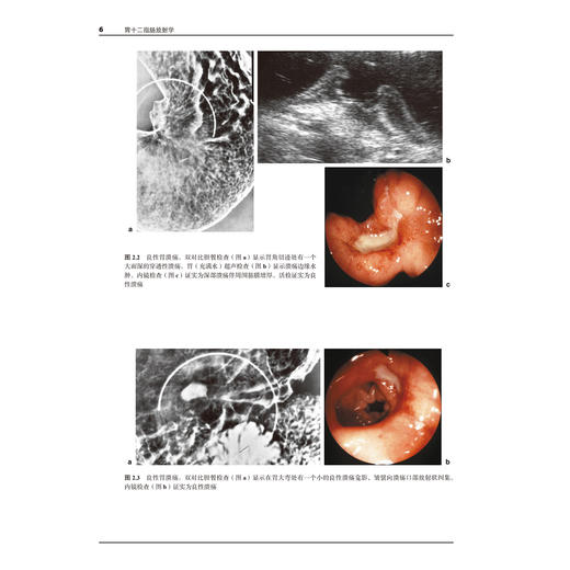 胃十二指肠放射学 张亚琴 史长征 崔恩铭 吴元魁 主译 结合具体案例对胃生理病理内镜等方面进行系统深入的阐述北京大学医学出版社 商品图4