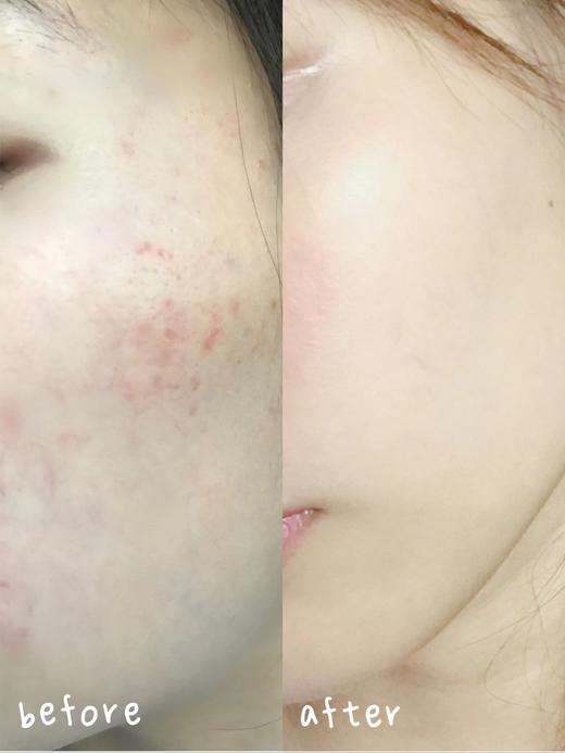 【多妈团购 明星同款Lalisse莱依诗祛痘精华】青春期必备 中草药香，温和祛痘，植物萃取不伤肤，祛痘、淡印，少反复好吸收，自带滚珠，好涂抹，效果肉眼可见-咸喜仓 商品图10