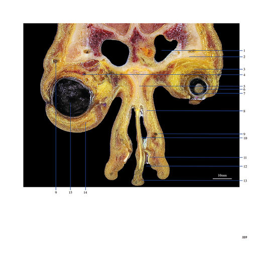 高精度眼耳鼻颅底冠状面断层解剖与CT对照图谱 陈向东 蔡莉 截取眼、耳、鼻及毗邻颅底的局部区域图像 共112幅图像 人民卫生出版社 商品图4