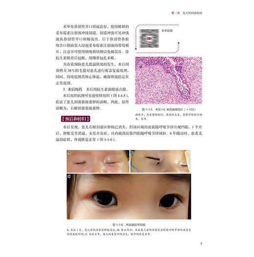 中山泪道相关疾病疑难病例解析 2025版（中山眼科疑难眼病系列）梁轩伟 陈荣新 主编 西医 眼科学 9787117388399 人民卫生出版社 商品图4
