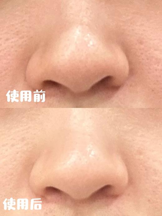韩国oliveyoung热卖爆品ilso一苏黑头导出液150ml黑头水控油祛黑头粉刺温和无刺激【含湿敷棉片*1盒+黑头铲*1】 商品图4