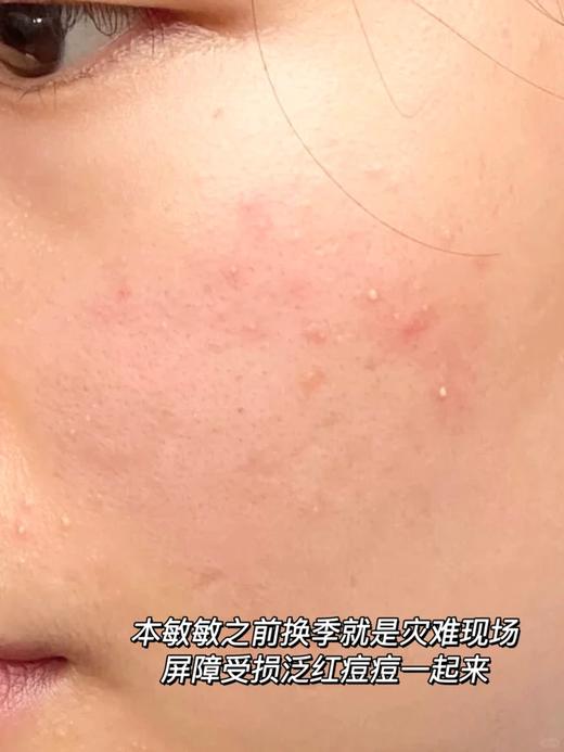 【伯纳赫重组胶原蛋白凝胶敷料30g】肤感清爽，成分安全无刺激，有修护肌肤屏障的功能！非慢性创面如面部痤疮引起的皮肤屏障损伤及周围皮肤的护理，中通快递 商品图11