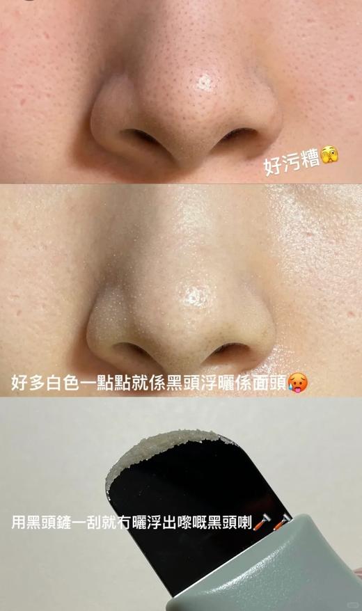 韩国oliveyoung热卖爆品#ilso一苏黑头导出液150ml+冷敷仪套组 商品图4