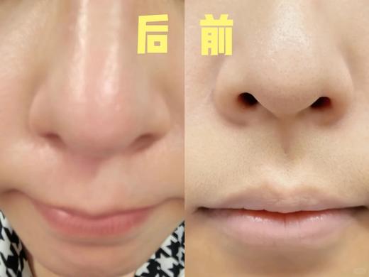 韩国oliveyoung热卖爆品#ilso一苏黑头导出液150ml黑头水控油祛黑头粉刺温和无刺激 商品图4