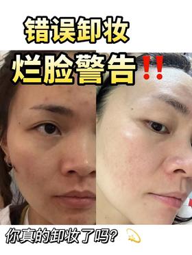 痘痘肌！你有没有想过长痘可能是因为卸妆没卸对🤬