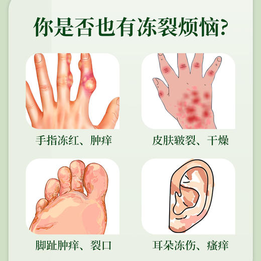云南本草冻疮膏止痒冻伤膏护手霜防冻疮防裂消肿冻手儿童正品冬季 商品图1
