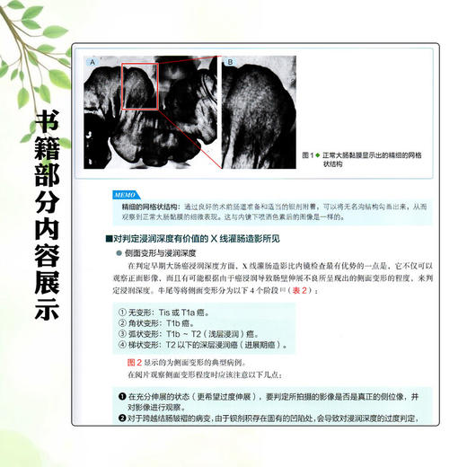 大肠EMRESD 通过病例学习最适合病变的治疗策略 修订版 唐秀芬 主译 消化科 消化内镜 临床医学 9787559132116辽宁科学技术出版社 商品图4