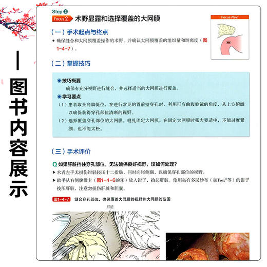 良性/急症的标准化腹腔镜手术：消化道篇 掌握手术技巧 附视频 王利明 主译 消化外科学 9787559141248 辽宁科学技术出版社 商品图4