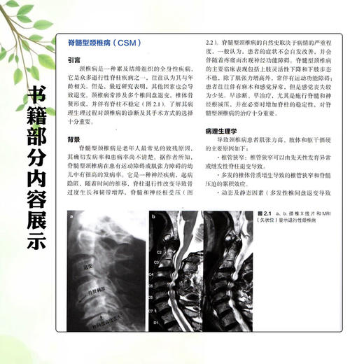 脊髓型颈椎病和后纵韧带骨化 曹凯 陈雄生 张雪松 主译 脊髓型颈椎病与后纵韧带骨化症的病理生理学 骨科学 辽宁科学技术出版社 商品图4