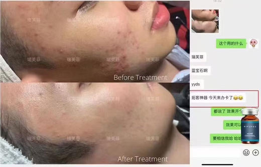 瑞芙菲蓝宝石祛痘精华5ml单支  西班牙原装淡化痘印痘坑粉刺MTS水光精华液 商品图2