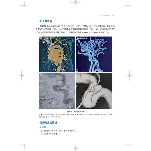 脑血管病介入治疗：OCIN病例精选 刘建民 杨鹏飞 赵开军 适用神经外科和神经内科及相关专业的临床医师、师生 上海科学技术出版社 商品图4