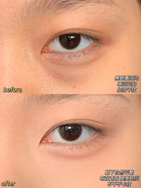 黑眼圈泪沟消失术！新手get妈生眼平整度