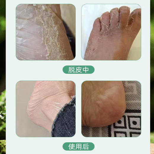 【陈沅堂抑菌液赠真菌快克】真菌困扰救星！ 专攻脚气脱皮瘙痒 草本温和根治 180ml/瓶 商品图3