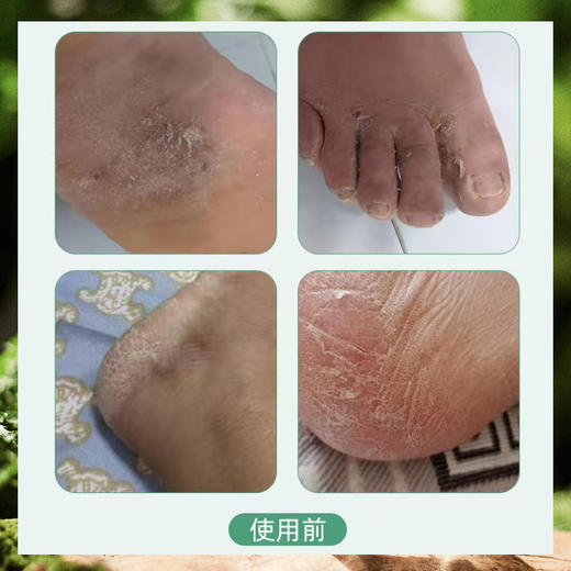 【陈沅堂抑菌液赠真菌快克】真菌困扰救星！ 专攻脚气脱皮瘙痒 草本温和根治 180ml/瓶 商品图4