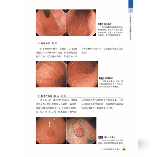 白光寻癌 早期胃癌的检出及诊断（日）平泽俊明 等著 汪旭 刘国伟 译 肿瘤医学 9787559142207 辽宁科学技术出版社 商品图4