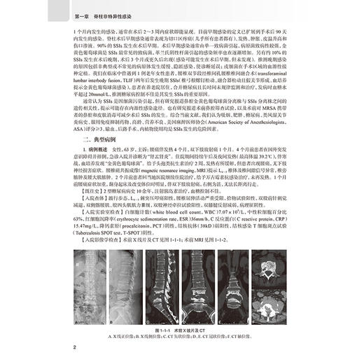 脊柱感染病例诊疗荟萃 崔旭 陶笙 主编 详细阐述脊柱结核误诊行椎体强化术患者的治疗原则和方法 9787117390040 人民卫生出版社 商品图4