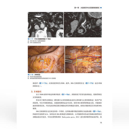 日本绢笠式TMDU 大肠癌手术 附赠视频 [日]绢笠祐介 主编 王利明 于向阳 主译 9787559142467 辽宁科学技术出版社 商品图3