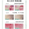 【江苏银行内购】绽媄娅祛痘控油次抛精华液温和战痘不反复 商品缩略图1