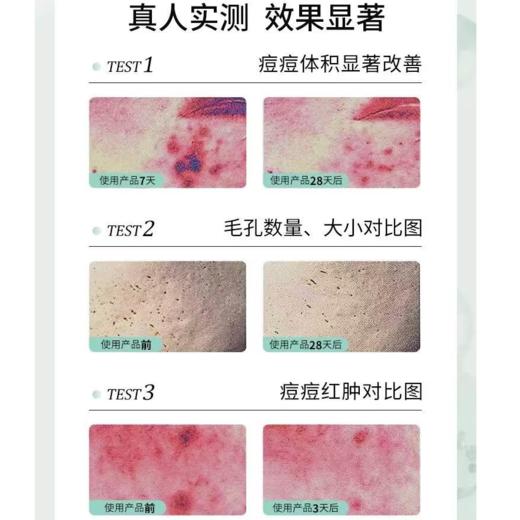 【江苏银行内购】绽媄娅祛痘控油次抛精华液温和战痘不反复 商品图1