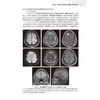 颅脑肿瘤影像诊断学 李军 主编 旨在为影像医学与核医学专业医师提供更详细的脑肿瘤影像学习和参考依据 肿瘤学 人民卫生出版社 商品缩略图4