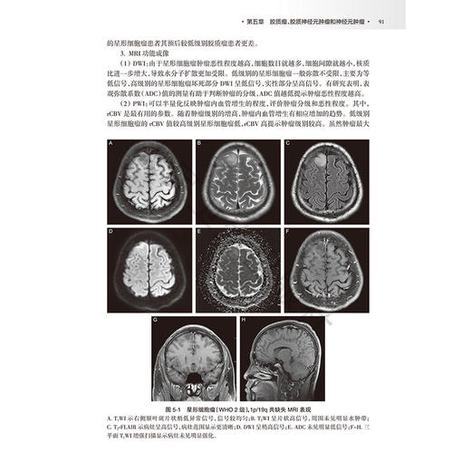 颅脑肿瘤影像诊断学 李军 主编 旨在为影像医学与核医学专业医师提供更详细的脑肿瘤影像学习和参考依据 肿瘤学 人民卫生出版社 商品图4