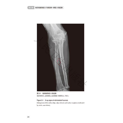地方性氟骨症X线诊断图谱 王丽华 高彦辉 主编 正常人体四肢及骨盆X线征象 容易与氟骨症相混淆的X线征象等 人民卫生出版社 商品图4