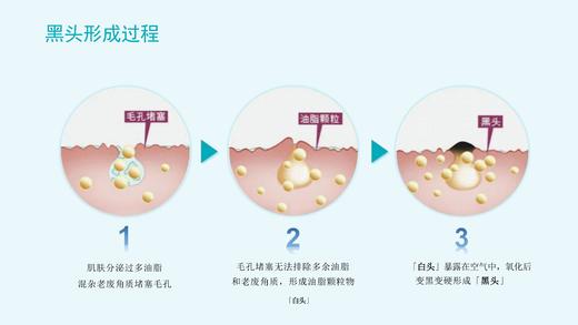 olive young爆款！ilso一苏黑头导出液韩国进口黑头水控油去黑头粉刺全脸深层清洁100g 商品图4