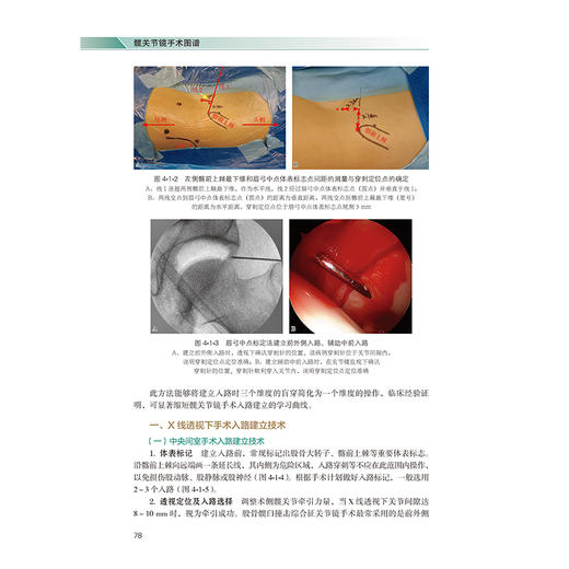 髋关节镜手术图谱 实用关节镜手术系列 李春宝 刘玉杰 主编 本书对目前髋关节镜的手术实践进行深度凝练与总结 北京大学医学出版社 商品图4