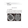 中枢神经系统疾病放射影像诊断思维与决策 洪楠 朱文珍 住院医师规范化培训结业临床实践能力考核标准方案解读丛书 人民卫生出版社 商品缩略图4