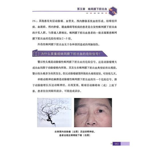 脑血管疾病管理手册 健康中国疾病管理丛书 赵继宗 王拥军 主编 病种包括卒中、颅内动脉瘤、脑动静脉畸形等 科学技术文献出版社 商品图4