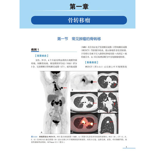 脊柱肿瘤 PETCT 图谱 张卫方 宋乐 祝安惠 赵梅莘 脊髓疾病 神经组织肿瘤 影像诊断 图谱 影像学9787565935190北京大学医学出版社 商品图4