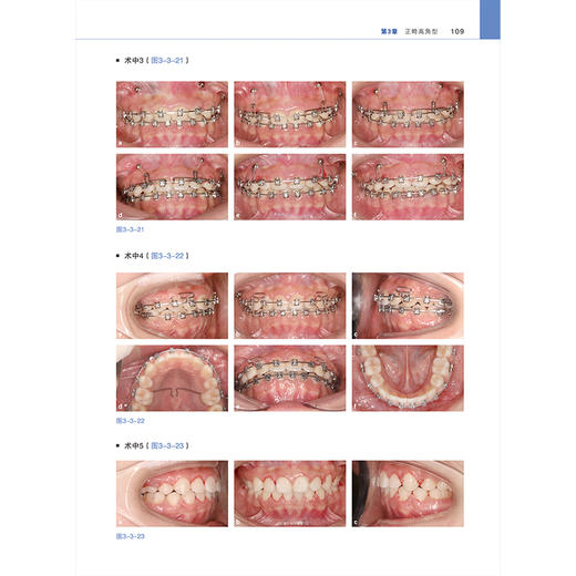 口腔正畸不同垂直骨面型临床病例解析 祝东波 主编 内容涵盖实用临床正畸固定矫治技术病例 9787559144454 辽宁科学技术出版社 商品图4