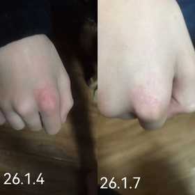 牛皮癣的用油调理，效果肉眼可见