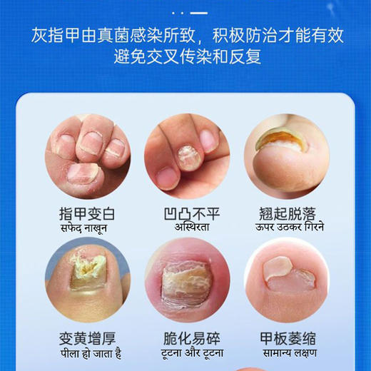 热卖中！！【源自印度 984 制药实验室】 灰指修复液，深层渗透抑菌，滋养修护护甲，形成保护层！ 商品图1
