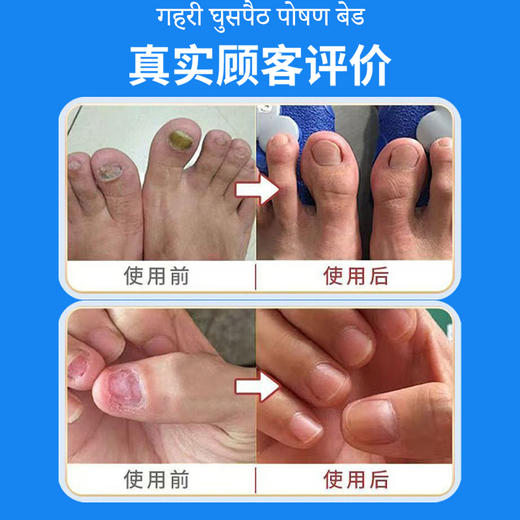 热卖中！！【源自印度 984 制药实验室】 灰指修复液，深层渗透抑菌，滋养修护护甲，形成保护层！ 商品图3