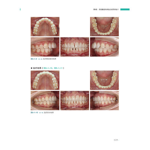 无托槽隐形矫治学 金作林 赵志河 主编 全面涵盖无托槽隐形矫治的发展历程及各类错??畸形的诊断与治疗策略 辽宁科学技术出版社 商品图4
