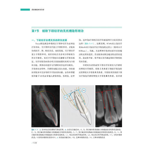 无托槽隐形矫治学 金作林 赵志河 主编 全面涵盖无托槽隐形矫治的发展历程及各类错??畸形的诊断与治疗策略 辽宁科学技术出版社 商品图3