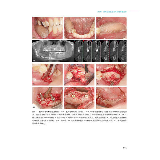 颌面缺损外科重建——旋骼深动脉瓣临床应用进阶 刘冰 贾俊 主编 旋髂深动脉髂骨瓣的解剖和制备 9787559145314辽宁科学技术出版社 商品图4