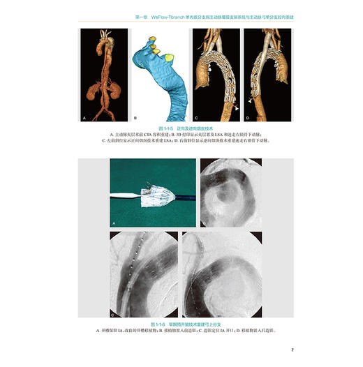 主动脉腔内修复——创新技术与临床实践 附操作视频 郭伟 主编 本书将详细介绍主编团队设计的各类腔内主动脉器材 人民卫生出版社 商品图4