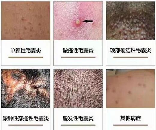 【JXXINLIN.泰国 毛囊清】专门针对皮炎长痘、痤疮、湿疹、敏感性皮肤引起的 商品图4