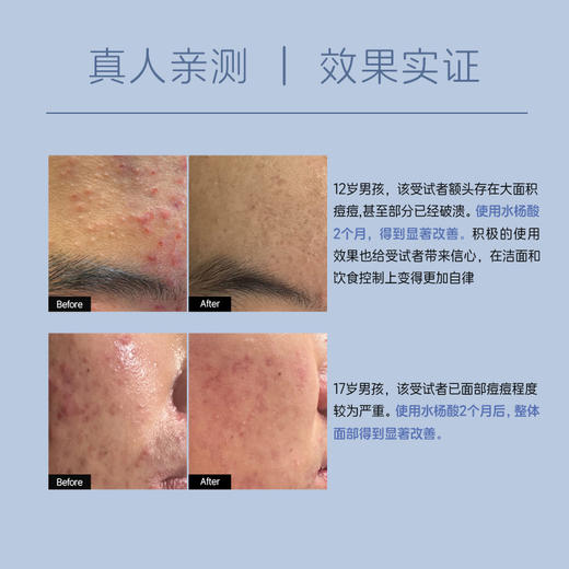 脸蛋更嫩滑 1盒尝鲜装！UNILIPO研知有理 水杨酸控油次抛精华液1ml*30支/痘肌/油性肌 商品图4