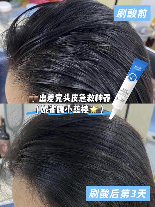 【美皮康专属】妮雀娜头皮复合酸（新）凝胶水杨酸刷酸去屑控油平衡修复 商品图1