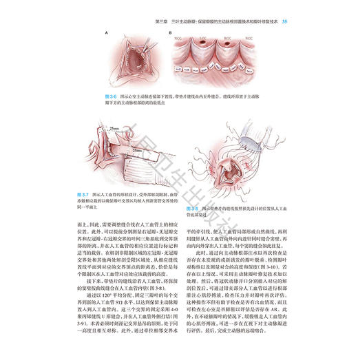 主动脉瓣修复 武忠 孙图成 段维勋 主译 详细介绍了主动脉瓣成形术的最先进的理念和技术等 外科学 9787117394833 人民卫生出版社 商品图4