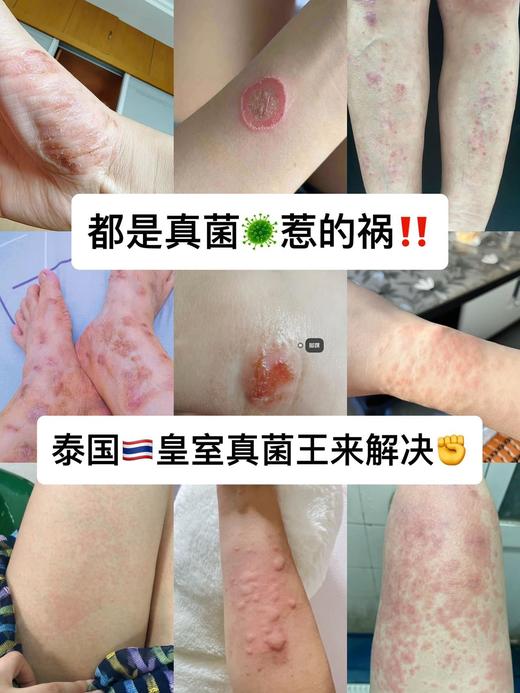 【JXXINLIN.泰国皇室真菌王】专为抑菌而生!!一瓶就能解决99%的皮肤问题，除臭+止痒+深层抑菌 商品图2