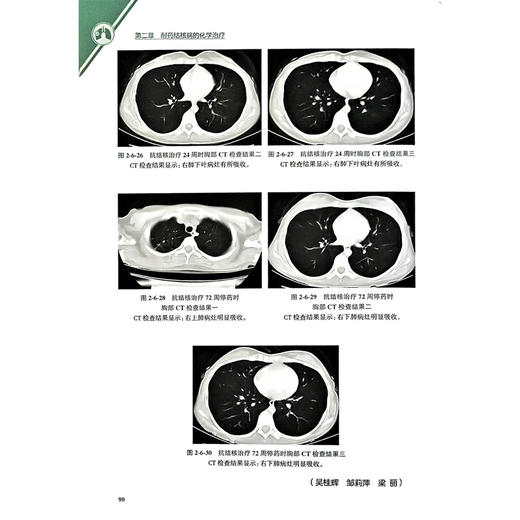 耐药结核病治疗 吴桂辉 蒋良双 主编 主要内容涵盖了耐药结核病治疗的各个方面 包括耐药结核病概述等9787117370141人民卫生出版社 商品图4
