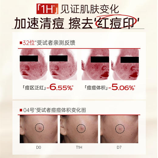 水杨酸祛痘精华液痘印痘坑控油修护淡化痘疤闭口粉刺黑头收缩毛孔|儒意官方商城 商品图1