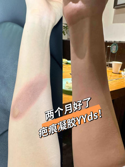【医用级 专供疤痕 到手两支】德国LAPOR 疤痕凝胶30gx2 祛疤淡印修复 商品图1